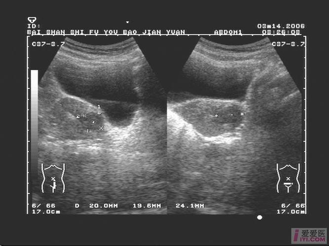 查子宫及附件彩超能查出来什么病「男子检查发现有子宫肌瘤」 电动车